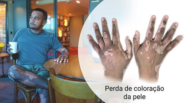 Dermatologista em Curitiba: O tratamento do Vitiligo pode controlar a doença, mas não curá-la.