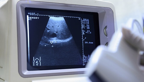 Ultrassom em Curitiba: A imagem mostra a tela de uma máquina de ultrassonografia, enquanto um exame está sendo realizado.