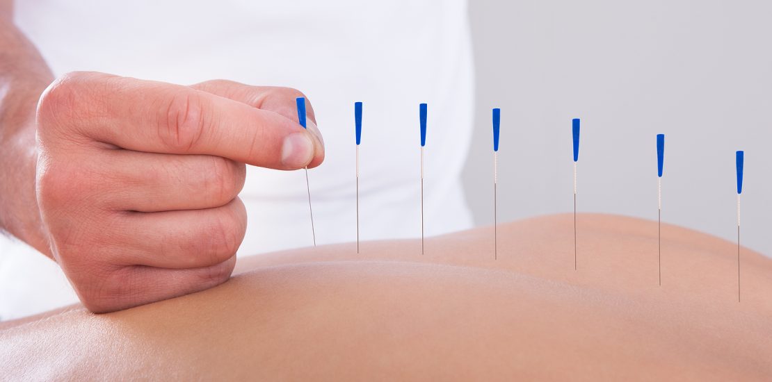 acupuntura agulhas