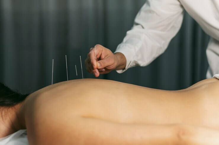 Benefícios da acupuntura para a saúde | Incórpore Centro Médico